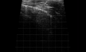 Right Thorax Landmark (Rib Space 5) - CCJ