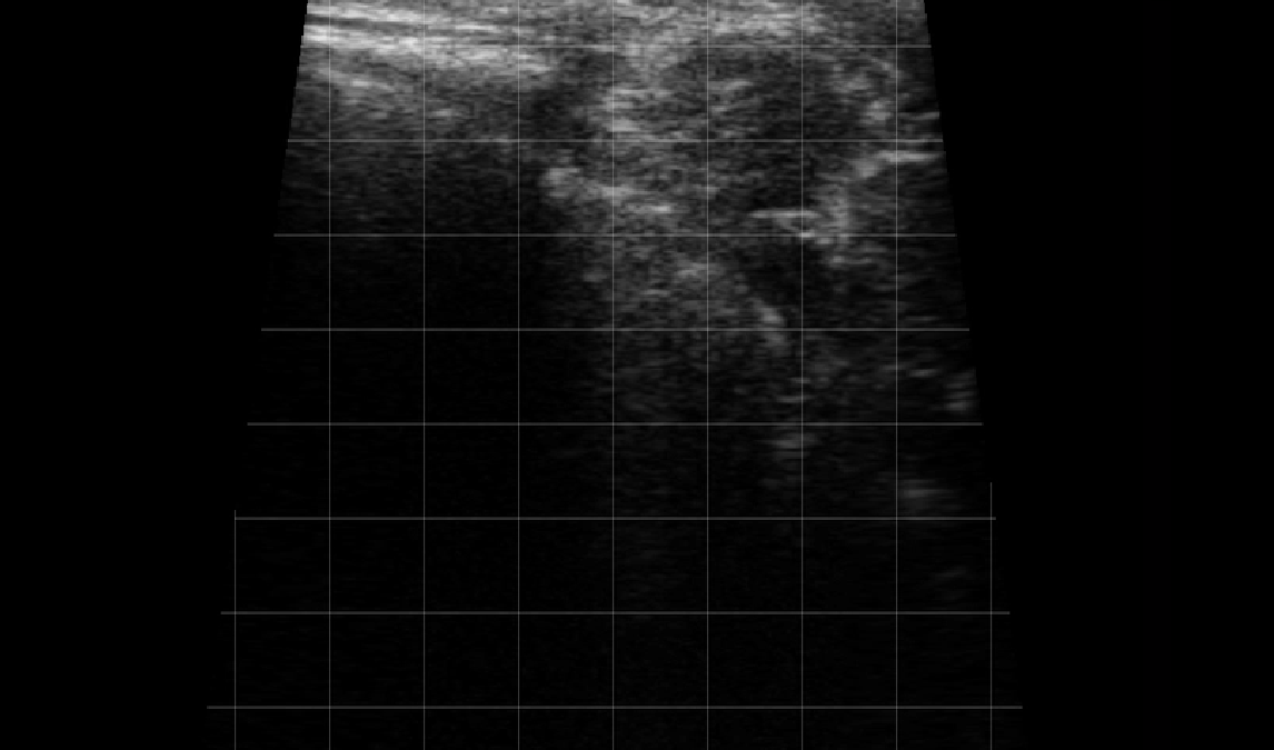 Left Thorax Landmark (Rib Space 5) – CCJ
