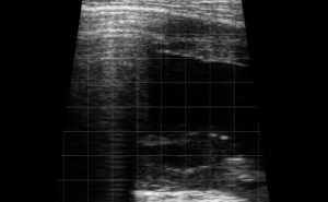 Right Thorax Landmark (Rib Space 3&4) - Heart