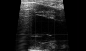 Left Thorax Landmark (Rib Space 3&4) - Heart