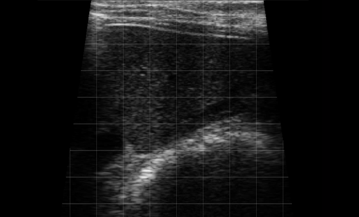 Right Thorax Landmark (Rib Space 6-10) – Liver