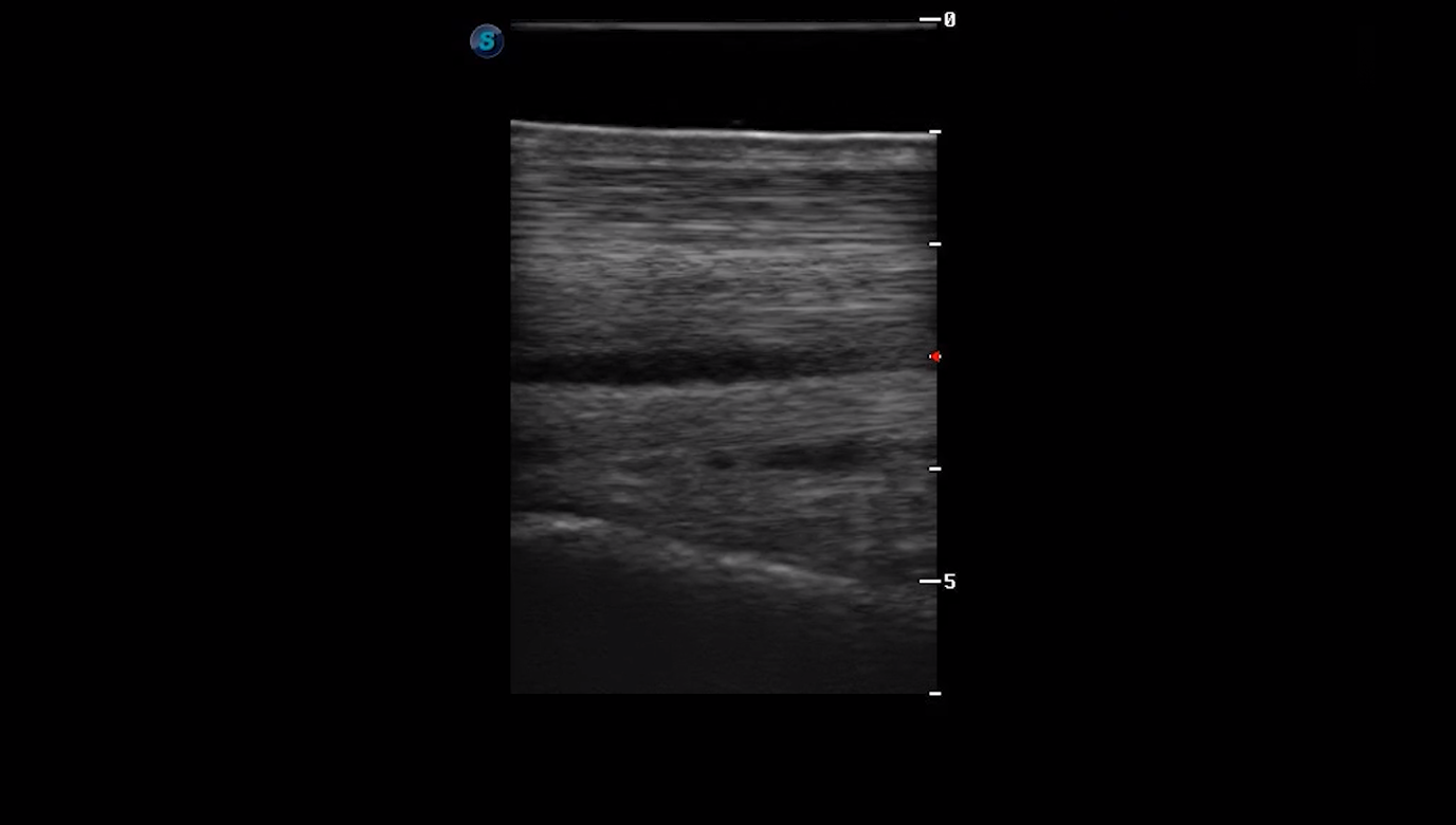 Metacarpal Region 1A (Longitudinal)