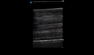 Metacarpal Region 1B (Longitudinal)