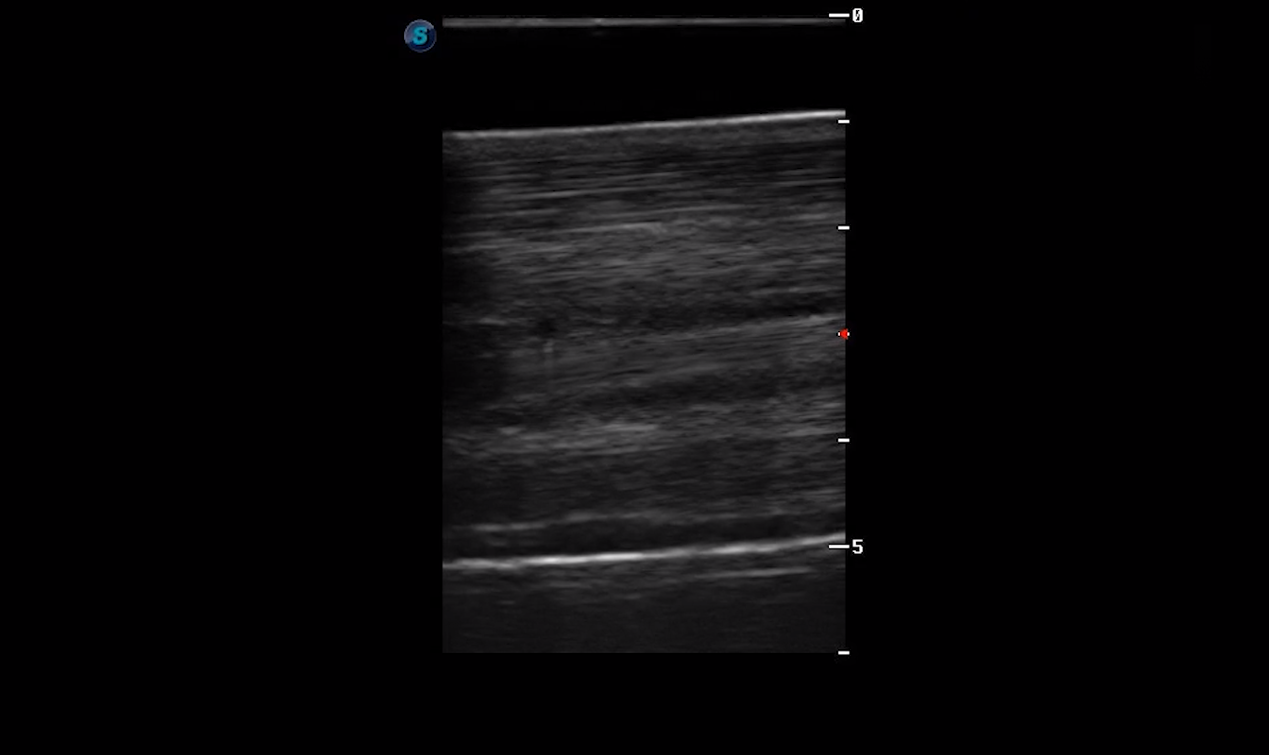 Metacarpal Region 1B (Longitudinal)