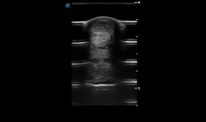 Metacarpal Region 1B (Transverse)