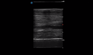 Metacarpal Region 2A (Longitudinal)