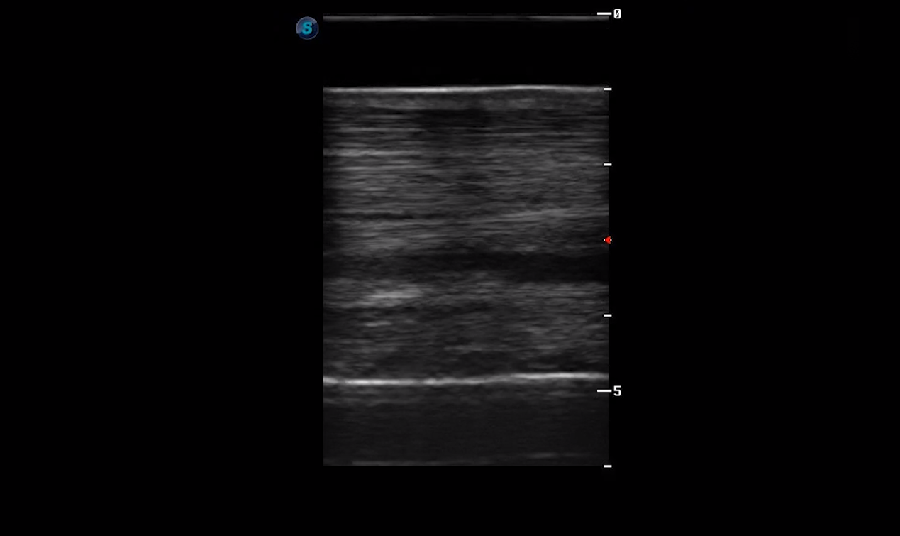 Metacarpal Region 2A (Longitudinal)