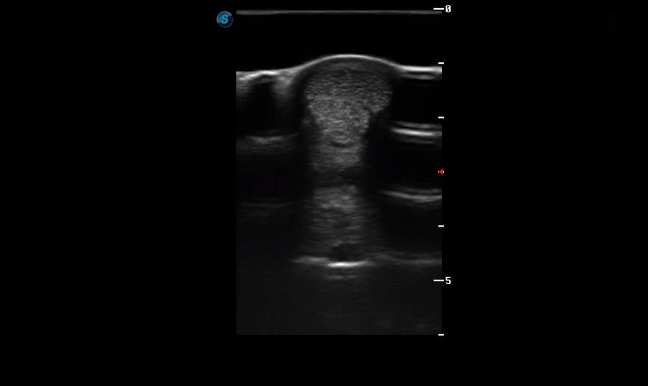 Metacarpal Region 2A (Transverse)