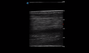 Metacarpal Region 2B (Longitudinal)