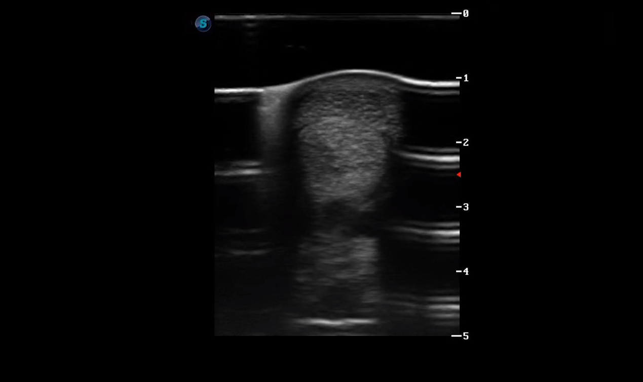 Metacarpal Region 2B (Transverse)