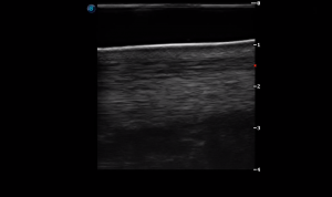 Metacarpal Region 3A (Longitudinal)