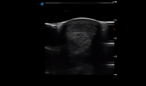 Metacarpal Region 3A (Transverse)