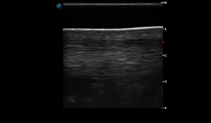 Metacarpal Region 3B (Longitudinal)