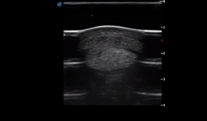 Metacarpal Region 3B (Transverse) 3