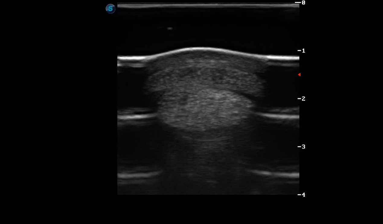 Metacarpal Region 3B (Transverse) 3