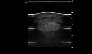 Metacarpal Region 3B (Transverse) 1