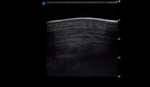 Metacarpal Region 3C (Longitudinal)
