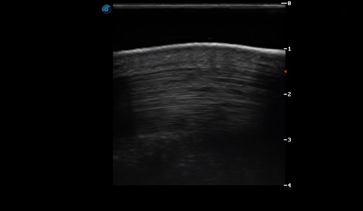Metacarpal Region 3C (Longitudinal)