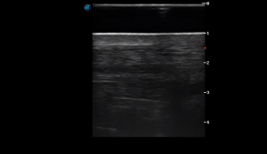 Metatarsal Region 1A (Longitudinal)