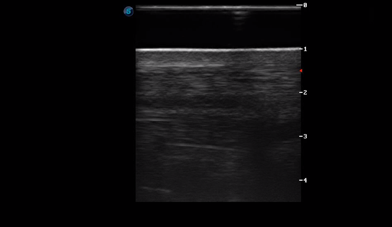 Metatarsal Region 1A (Longitudinal)