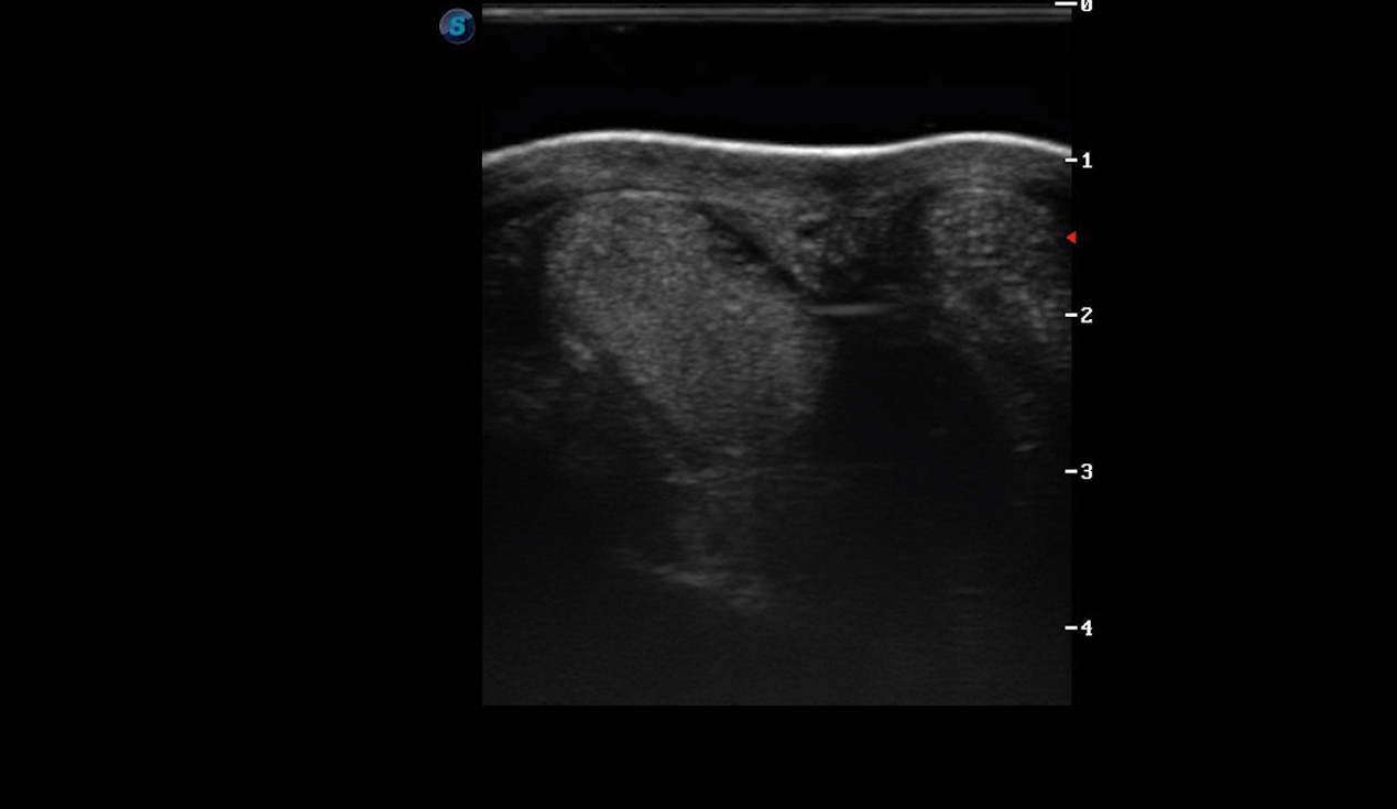 Metatarsal Region 1A (Transverse)