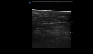 Metatarsal Region 1B (Longitudinal)