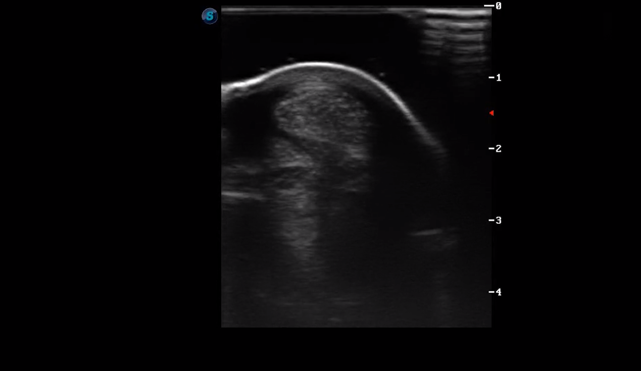 Metatarsal Region 1B (Transverse)