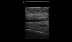 Metatarsal Region 2A (Longitudinal)