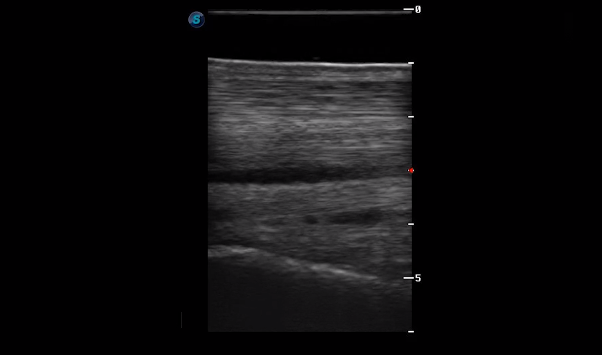 Metatarsal Region 2A (Longitudinal)