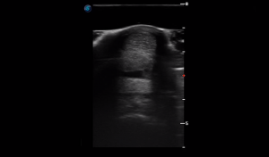 Metatarsal Region 2A (Transverse)