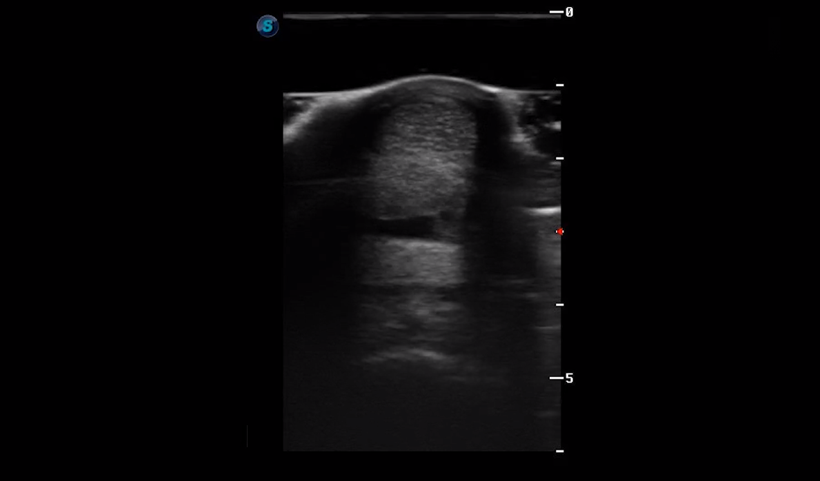 Metatarsal Region 2A (Transverse)