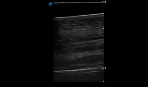 Metatarsal Region 2B (Longitudinal)