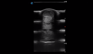 Metatarsal Region 2B (Transverse)