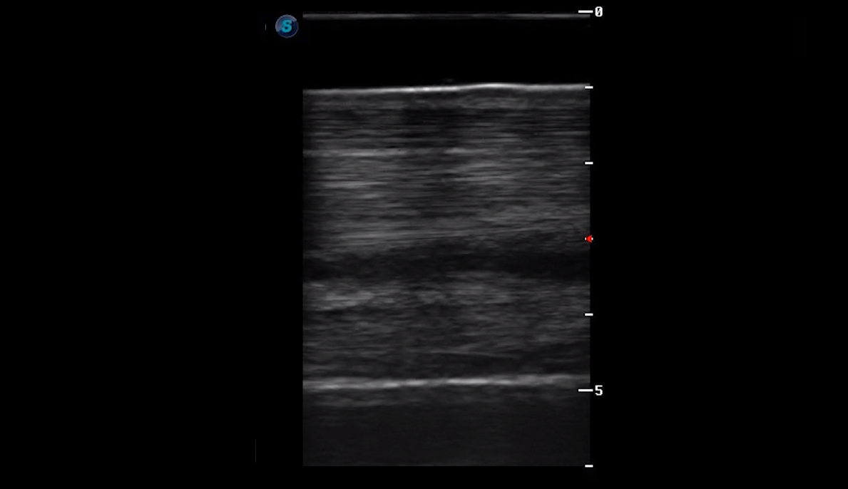 Metatarsal Region 3A (Longitudinal)