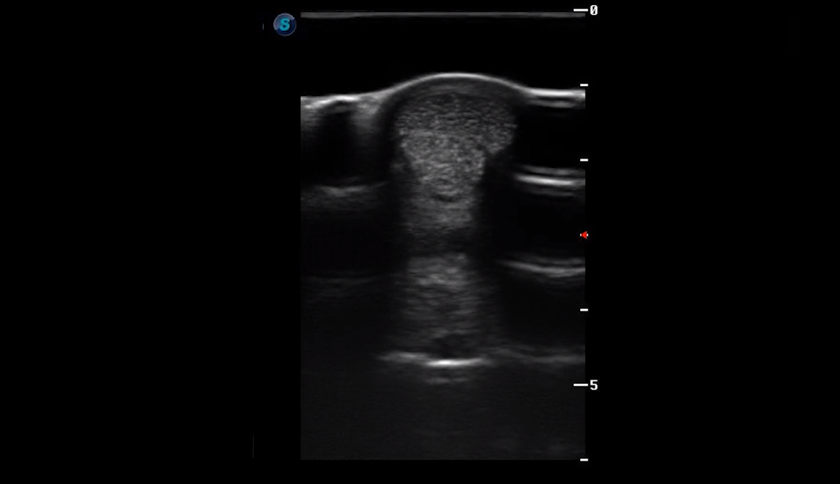 Metatarsal Region 3A (Transverse)