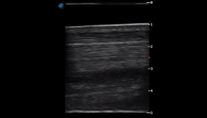 Metatarsal Region 3B (Longitudinal)