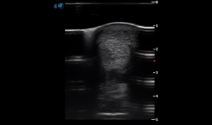 Metatarsal Region 3B (Transverse)