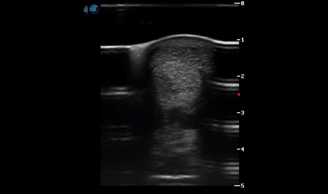 Metatarsal Region 3B (Transverse)