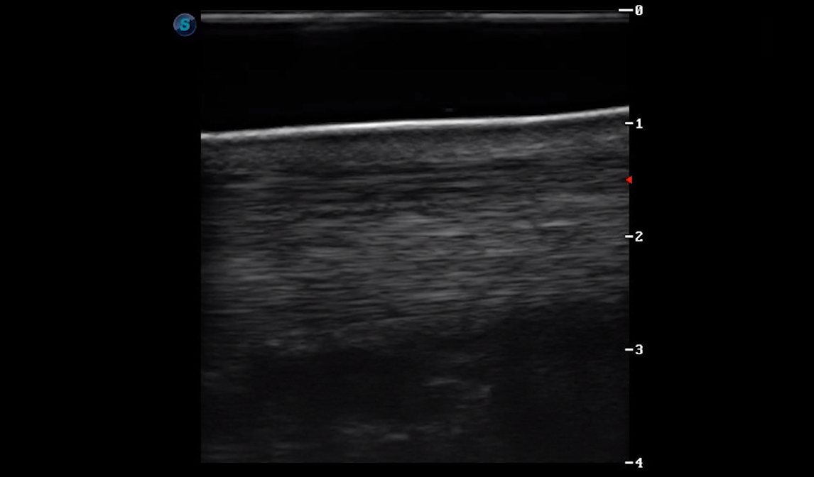 Metatarsal Region 4A (Longitudinal)