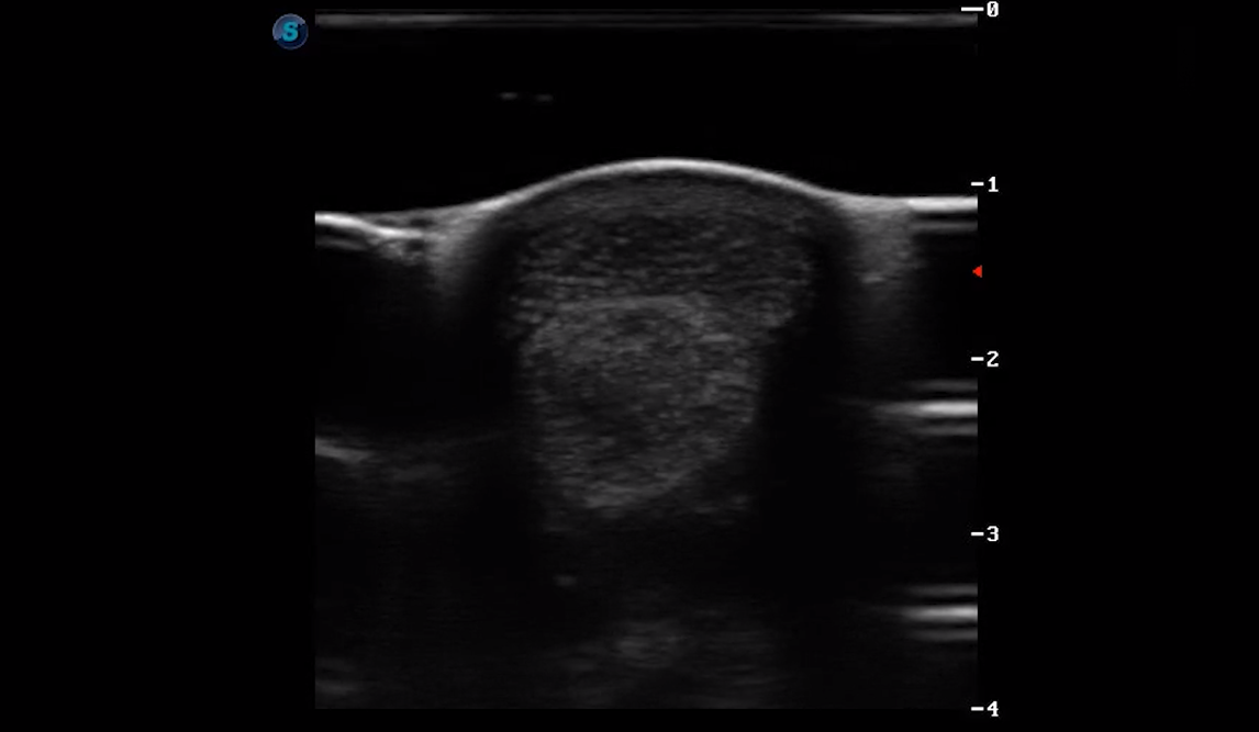 Metatarsal Region 4A (Transverse)