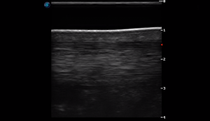 Metatarsal Region 4B (Longitudinal)