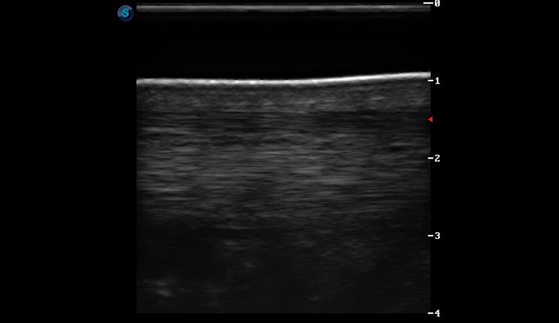 Metatarsal Region 4B (Longitudinal)