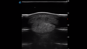 Metatarsal Region 4B (Transverse) 3