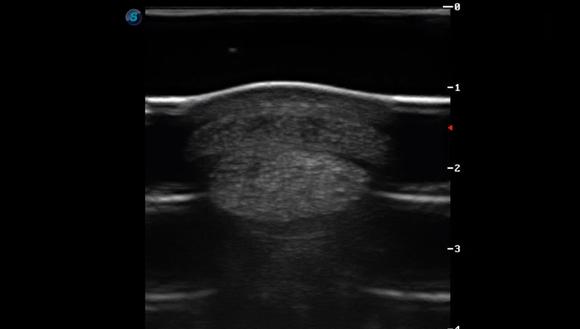 Metatarsal Region 4B (Transverse) 3