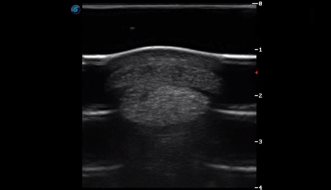 Metatarsal Region 4B (Transverse) 1