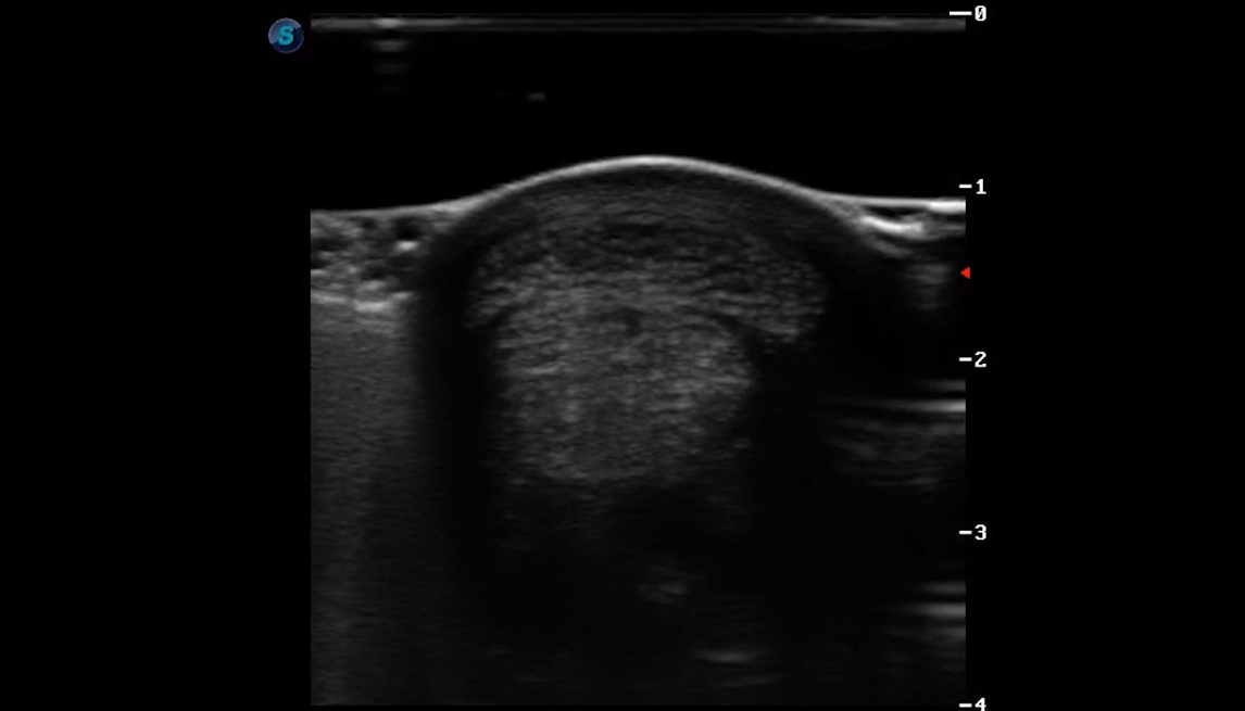 Metatarsal Region 4B (Transverse) 2