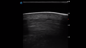 Metatarsal Region 4C (Longitudinal)