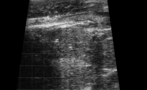 Calf Severe Lung Consolidation 1