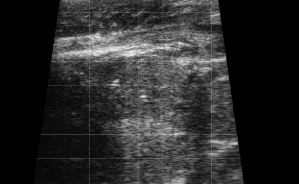 Calf Severe Lung Consolidation 1