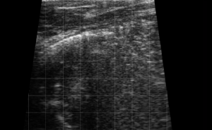 Calf Severe Lung Consolidation 2